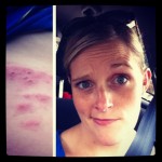 That Time I Got Motherfucking Shingles